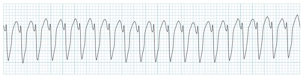 tachycardia