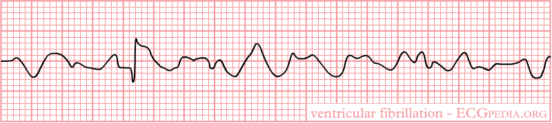 ventricular fibrillation